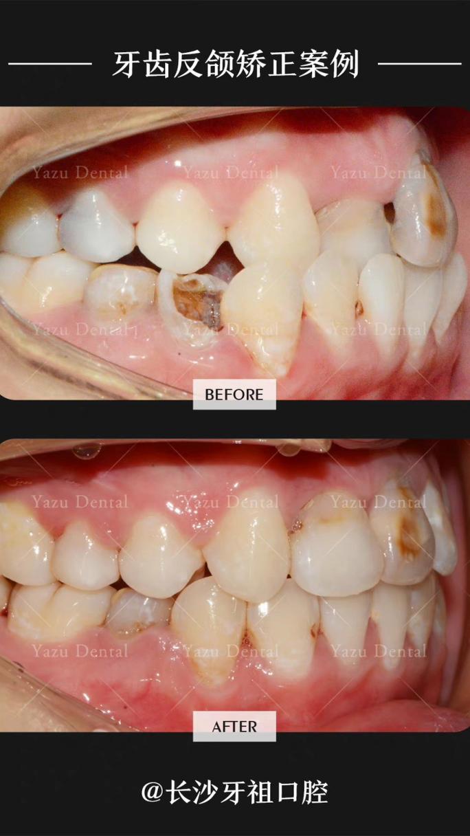 叶翁三杰正畸失败案例-图2