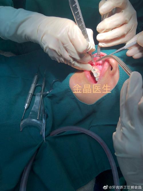 正畸骨皮质切开术视频，术式要点如何直观呈现？-图1