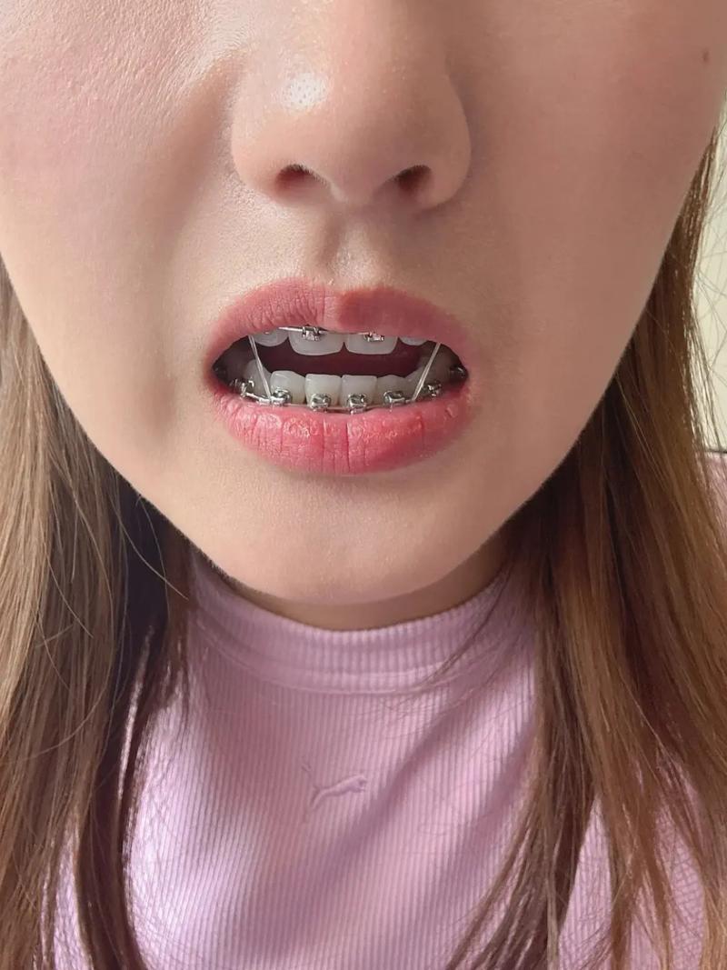 牙科正畸放橡皮筋视频该怎么操作？-图3