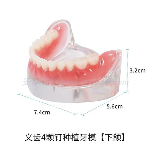 种植牙模型制作的具体方法有哪些？详细步骤与材料清单是什么？-图2
