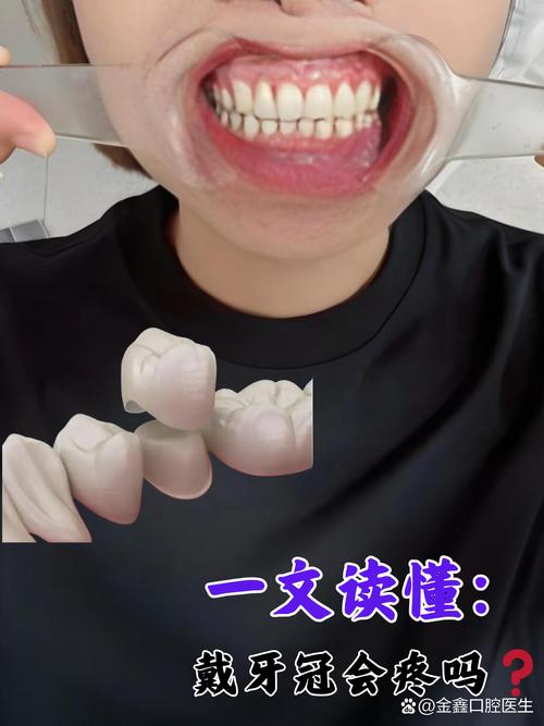 种牙之后戴牙冠会疼吗?戴牙冠的过程会有疼痛感吗?-图1 种牙之后戴牙冠会疼吗?戴牙冠的过程会有疼痛感吗?-图1