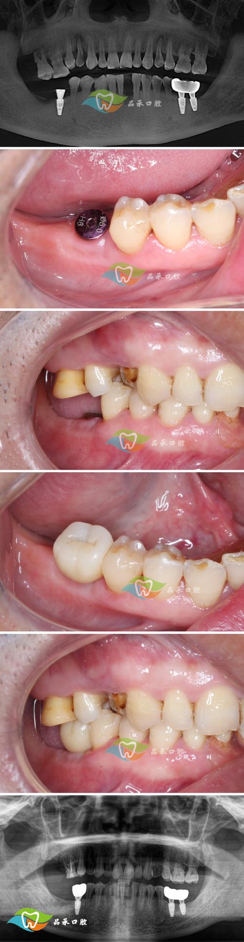 种牙之后戴牙冠会疼吗?戴牙冠的过程会有疼痛感吗?-图2 种牙之后戴牙冠会疼吗?戴牙冠的过程会有疼痛感吗?-图2