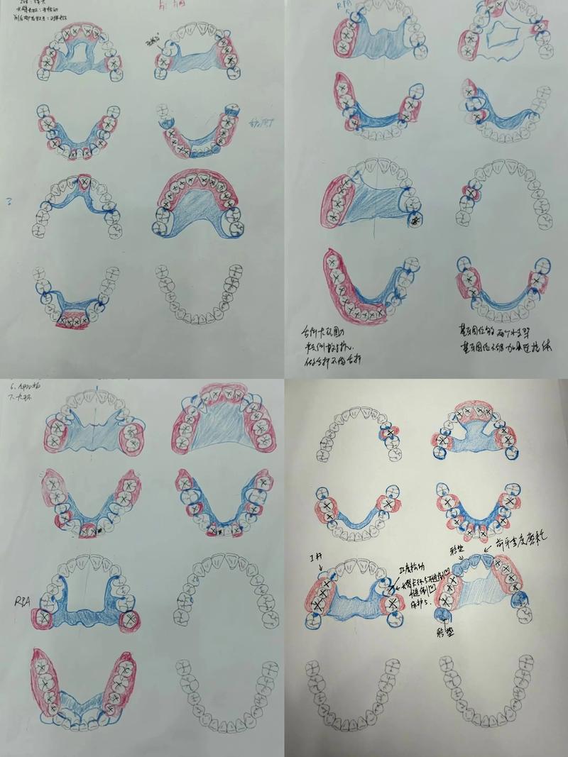 颌骨缺损重建方法如何选择？关键影响因素与临床策略是什么？-图2