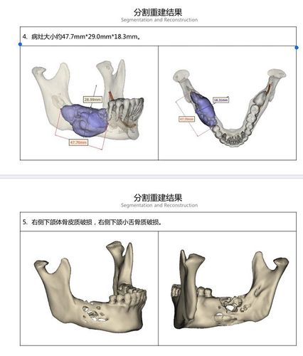 颌骨缺损重建方法如何选择？关键影响因素与临床策略是什么？-图1