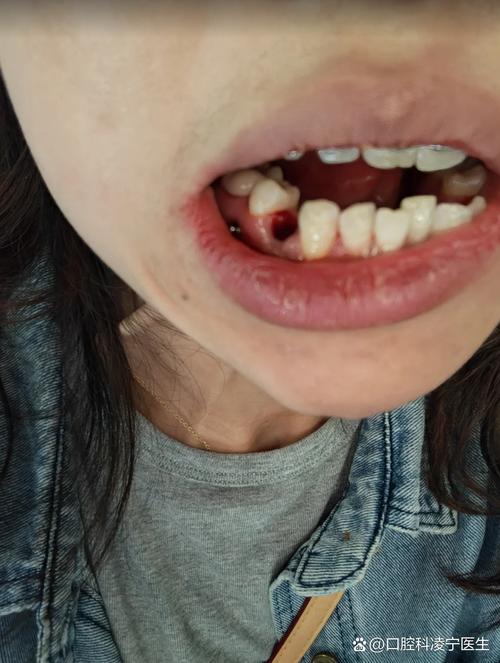 拔牙后正畸牙齿会疼吗-图1