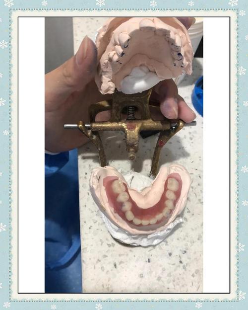 临时牙制作方法图片-图3