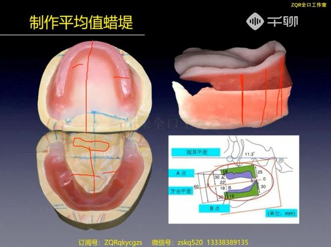 颌位关系记录的方法-图3