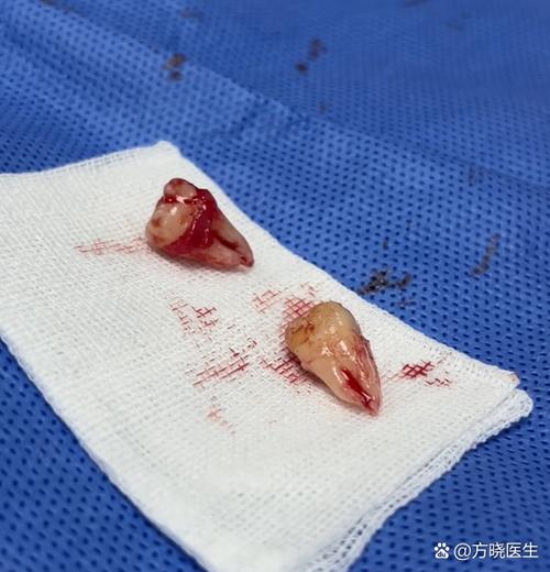 种牙跟拔牙比,哪个手术的疼痛程度更高?-图2 种牙跟拔牙比,哪个手术的疼痛程度更高?-图2