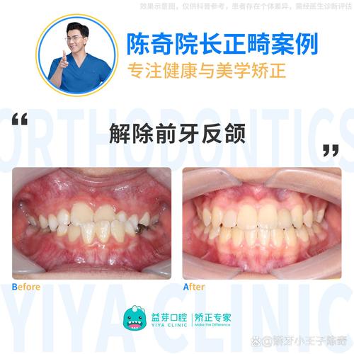 乳前牙反合的治疗方法有哪些？不同病例如何针对性选择？-图1