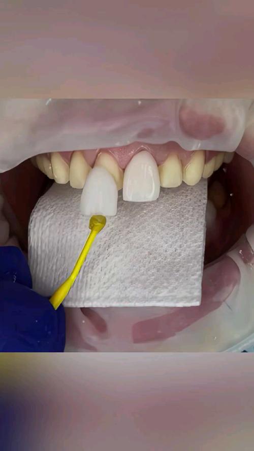 全瓷牙贴面制作方法的具体步骤与技术要点是什么？-图2