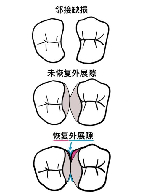 口腔正畸间隙四种方式-图2 口腔正畸间隙四种方式-图2