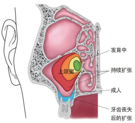 上颌窦底提升术常用方法有哪些？如何根据患者情况选择最佳术式？-图1