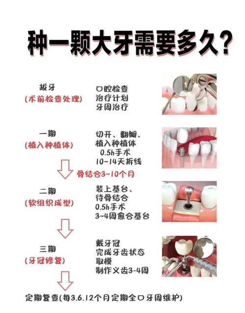 种牙时间与种植方法如何关联？不同方法耗时差异大吗？-图3