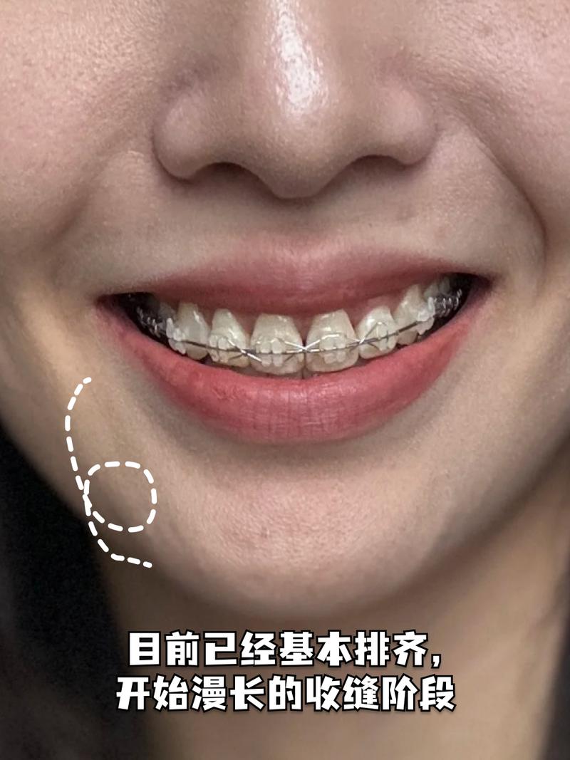 开颌术前必须正畸吗？-图3