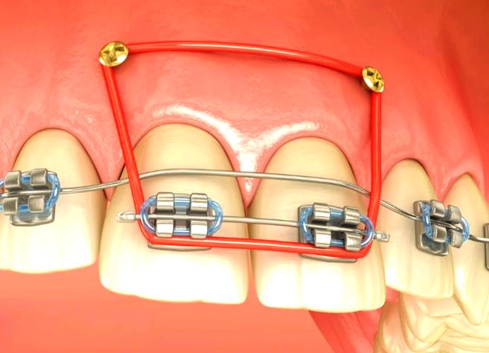 牙齿正畸为何用上皮筋？作用揭秘-图2