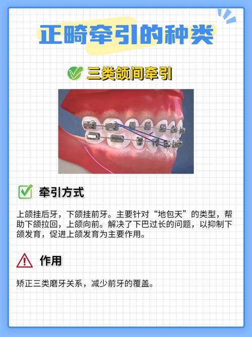 牙齿正畸为何用上皮筋？作用揭秘-图3