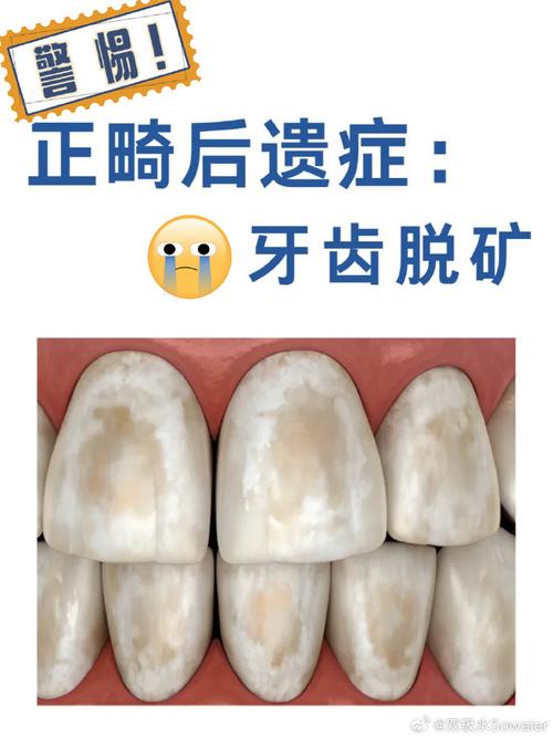 正畸会导致牙齿脱落吗？原因及预防方法有哪些？-图2