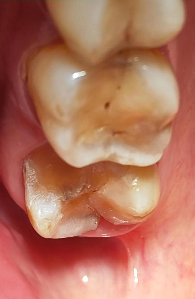 种牙后牙冠高度不够是什么原因？该如何处理？-图2