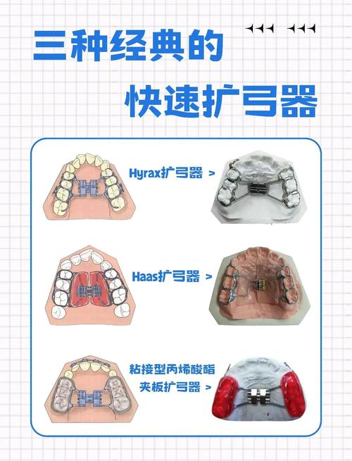 儿童牙齿扩弓的方法-图2 儿童牙齿扩弓的方法-图2