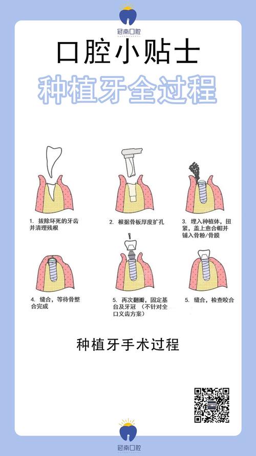 拔牙种牙流程要多久-图2