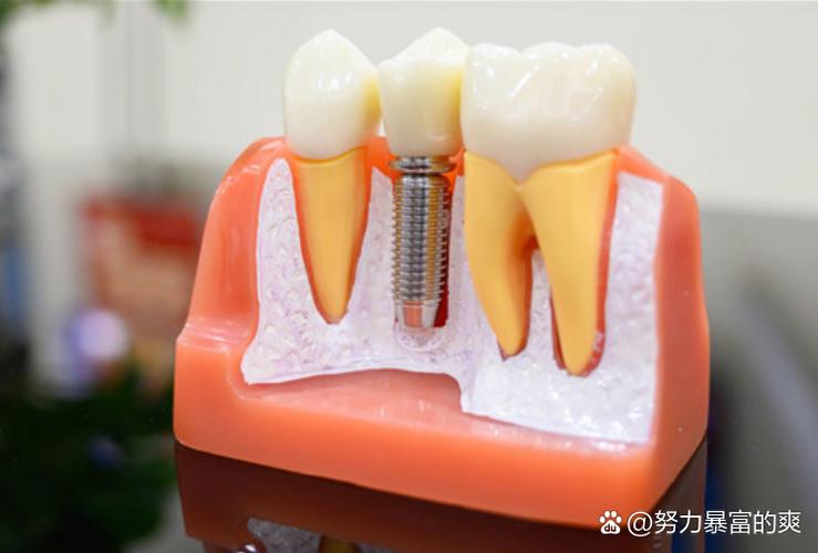 牙齿精密附件和种牙-图2