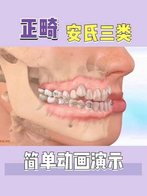 兜齿矫正有哪些方法？-图3