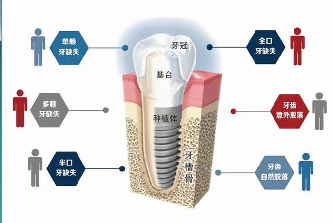 2025种植牙培训-图1