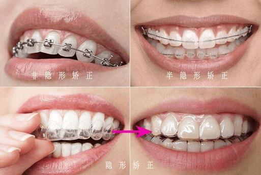 想正畸选哪家牙科医院比较好？-图2
