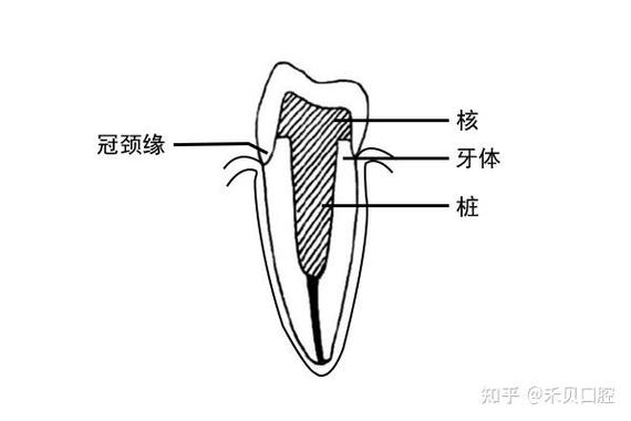 如何有效增加桩核固位？临床常用方法有哪些？-图2
