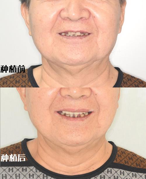 60多岁适合种牙吗-图1 60多岁适合种牙吗-图1