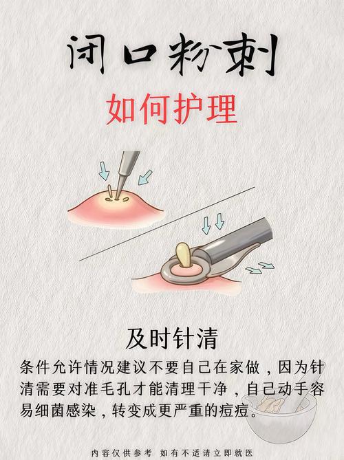 闭口式印模制取方法-图3 闭口式印模制取方法-图3