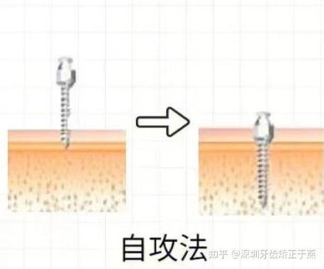 判断种植钉松动方法-图2