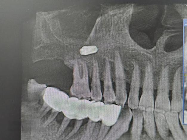上颌窦底穿处理方法-图1 上颌窦底穿处理方法-图1