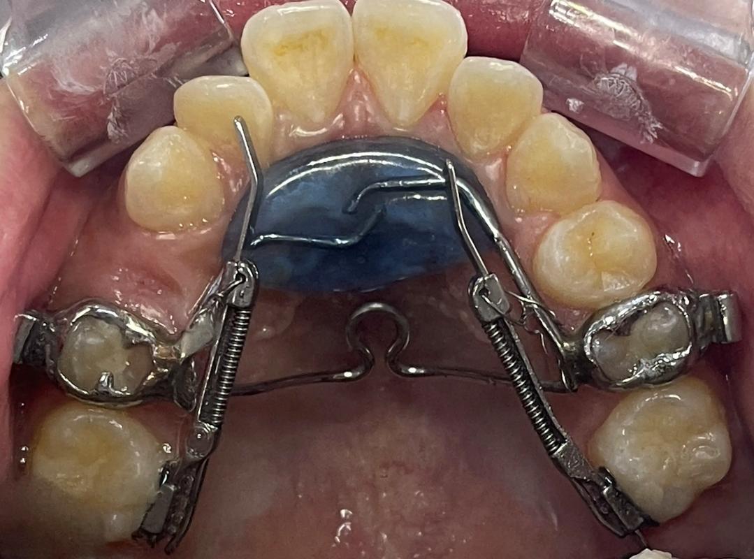 磨牙推进器如何正确安装？步骤与要点是什么？-图1