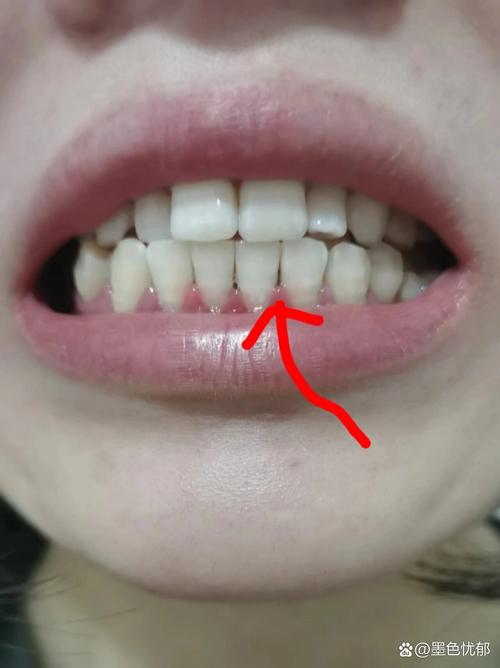 正畸之后门牙缝有黑点，是什么原因导致的？-图1