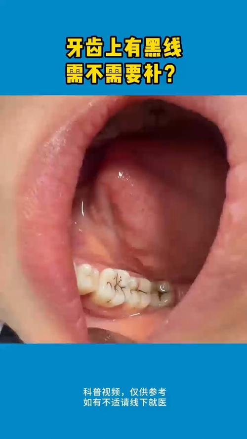 正畸之后门牙缝有黑点，是什么原因导致的？-图2