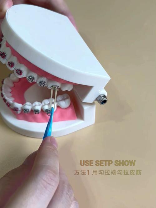 正畸牵引橡皮圈正确用法及注意事项有哪些？-图2