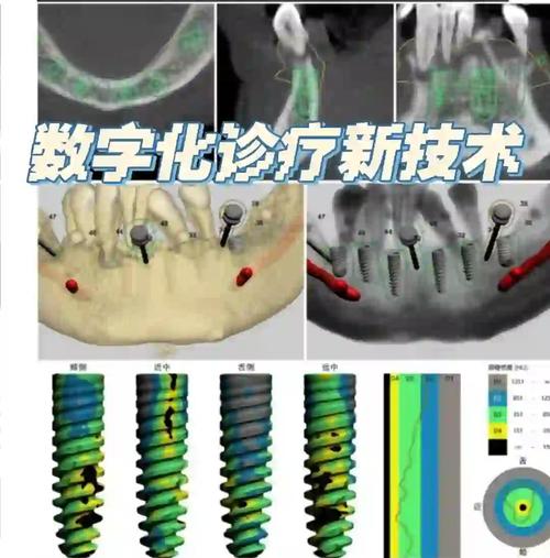 先进的数字化正畸技术-图3