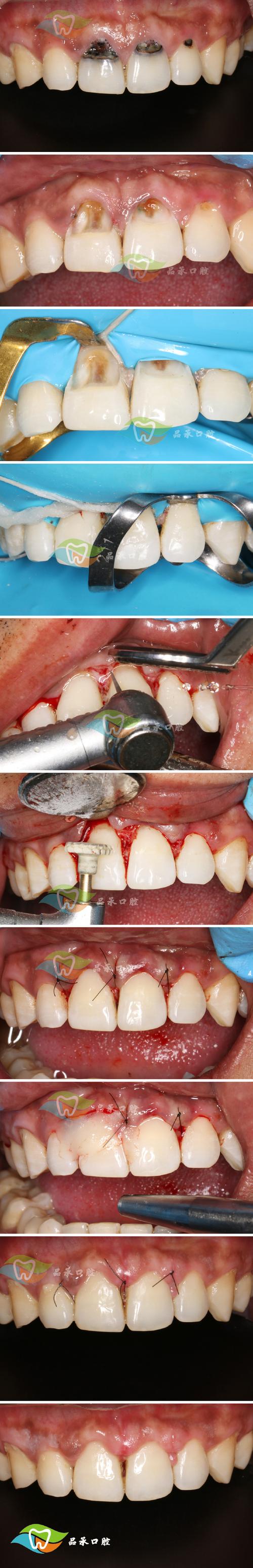 正畸骨皮质切开术的操作步骤、技术要点及临床应用注意事项有哪些？-图2
