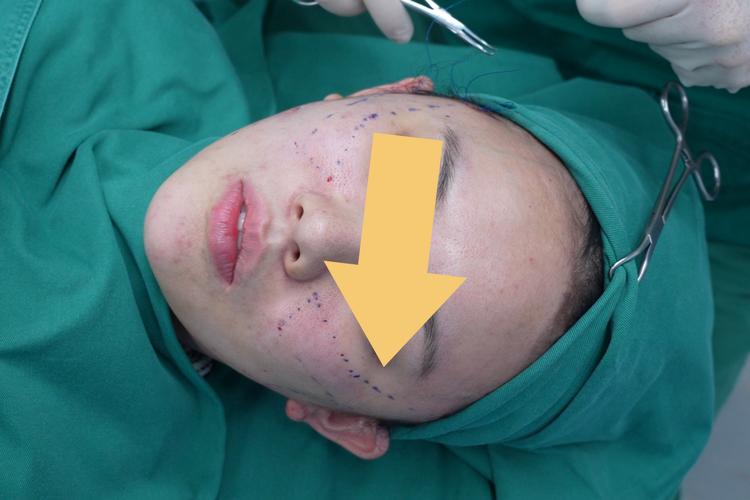 正畸骨皮质切开术的操作步骤、技术要点及临床应用注意事项有哪些？-图1