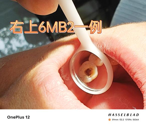 临床上如何准确确认根管长度的常用方法有哪些?-图3 临床上如何准确确认根管长度的常用方法有哪些?-图3