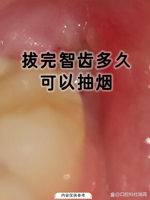 种牙之后多久能抽烟-图1