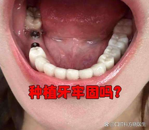 种牙失败有什么症状-图3