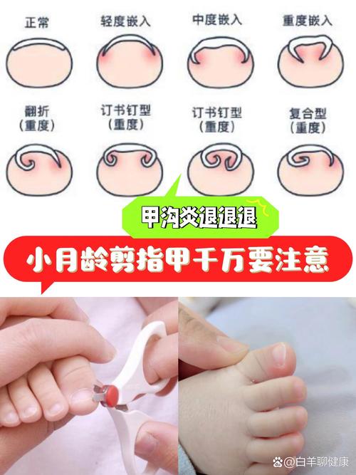 牙沟炎的最佳治疗方法是什么？如何选择最有效的治疗方式并预防复发？-图3