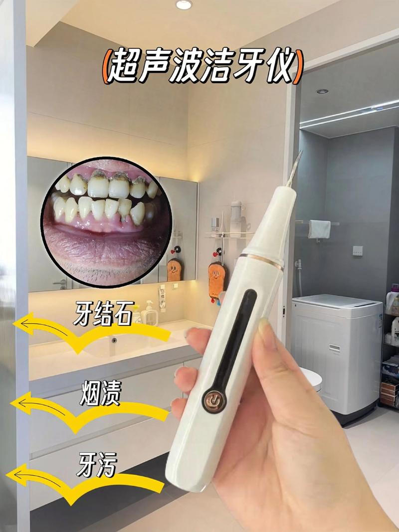 口腔超声波洁牙方法怎么做？过程安全吗？-图1