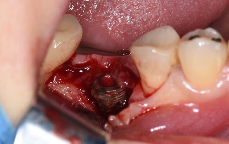 种牙失败后如何处理?这些实用方法要知道-图2 种牙失败后如何处理?这些实用方法要知道-图2