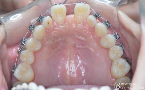 散在间隙正畸kq88,如何有效关闭牙齿间隙?-图3 散在间隙正畸kq88,如何有效关闭牙齿间隙?-图3