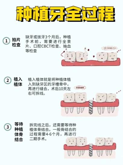 2025种牙成活率怎样?未来趋势与影响因素有哪些?-图2 2025种牙成活率怎样?未来趋势与影响因素有哪些?-图2