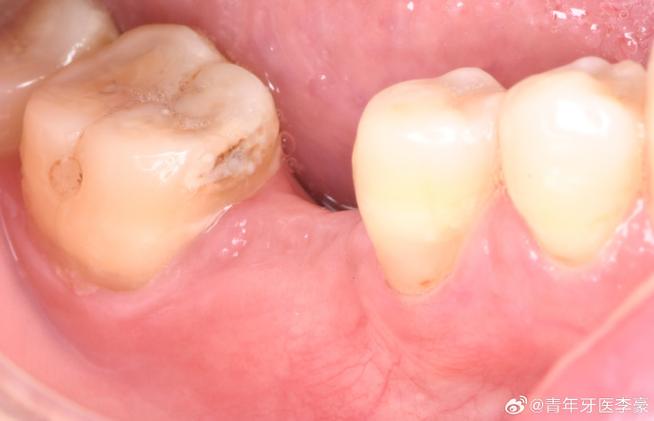 种牙植骨骨粉漏了?原因、风险与应对方法是什么?-图3 种牙植骨骨粉漏了?原因、风险与应对方法是什么?-图3