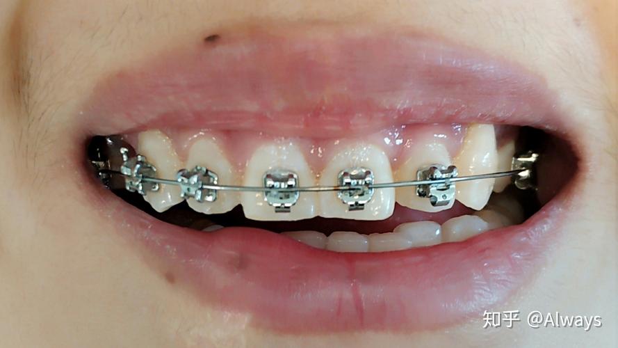 正畸自锁要换几次钢丝-图3